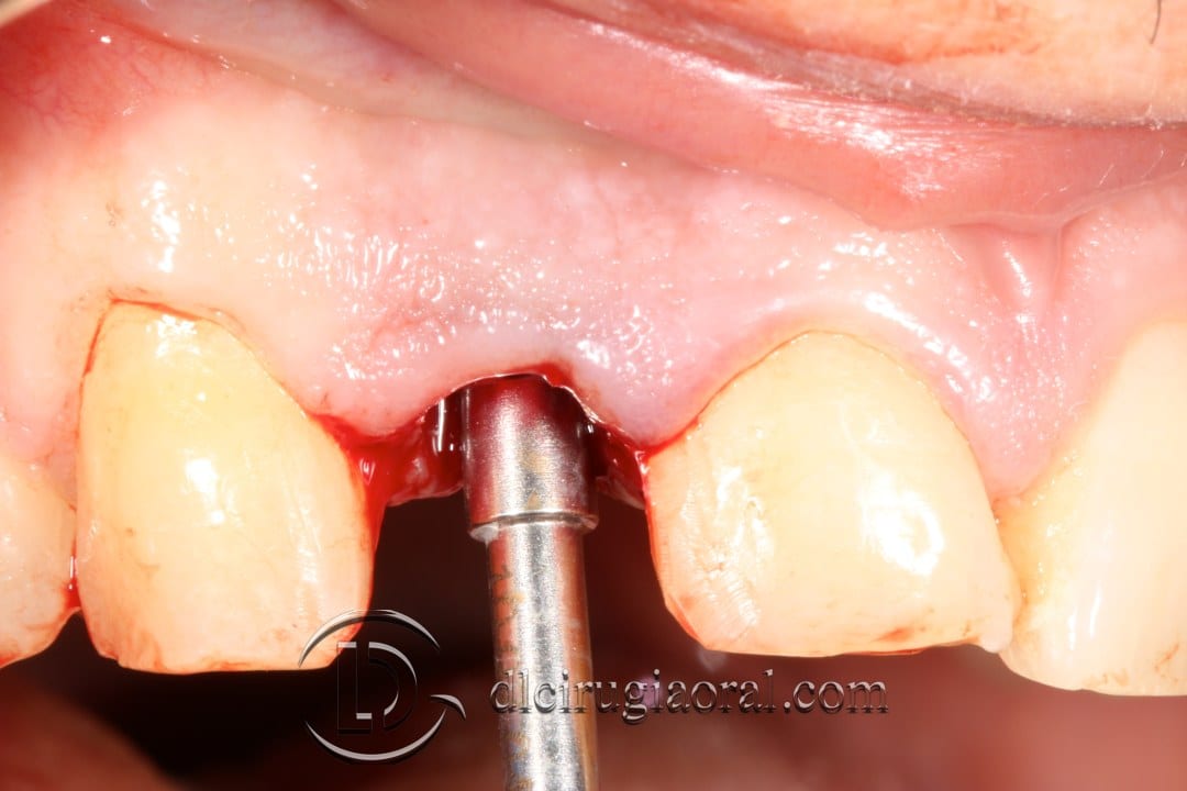 post-extraction implant