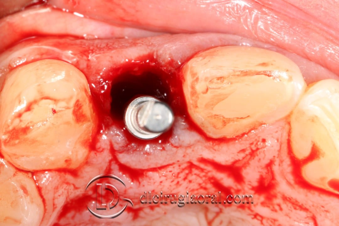 post-extraction implant
