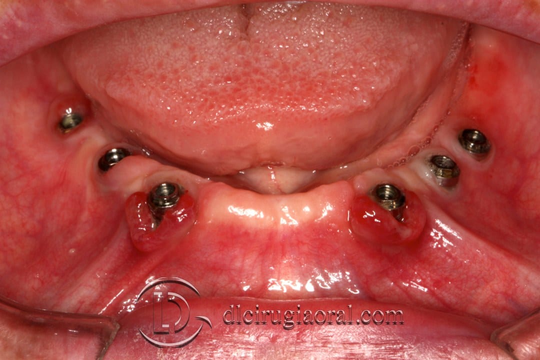 epithelial free graft