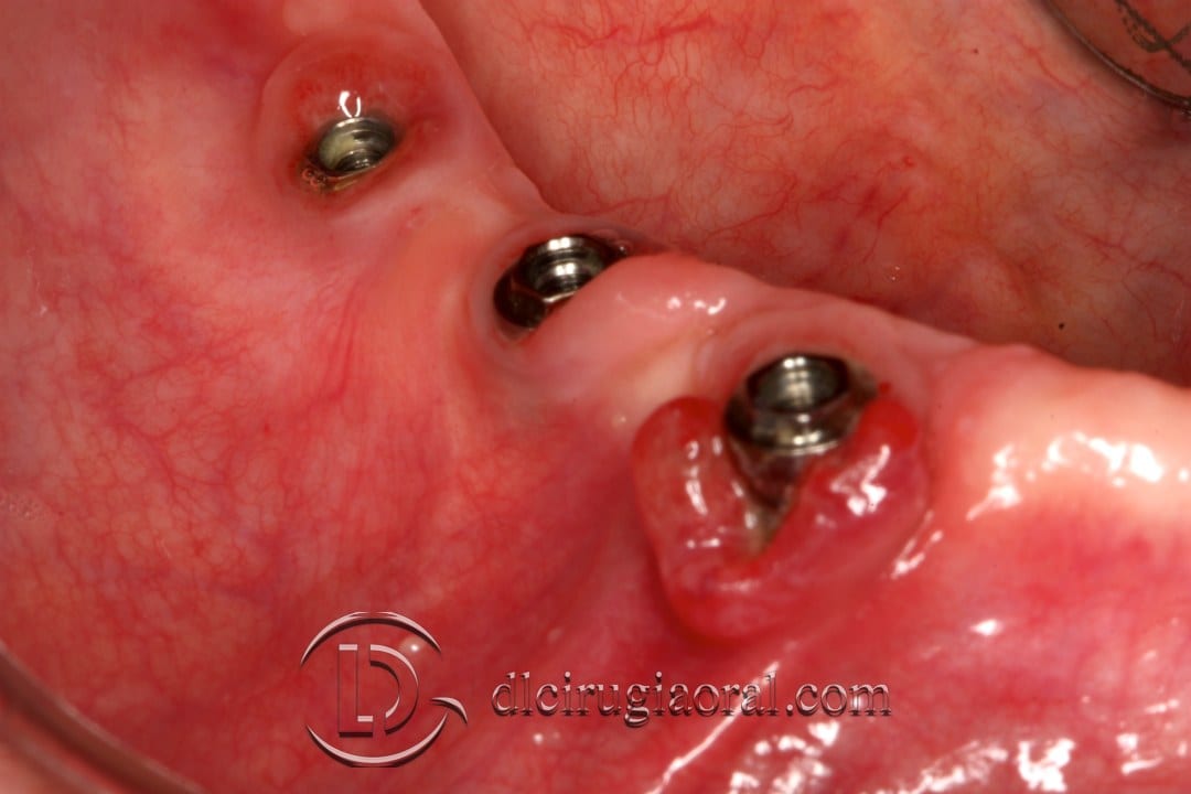 epithelial free graft