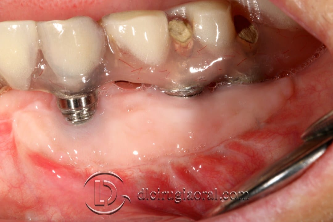 epithelial free graft