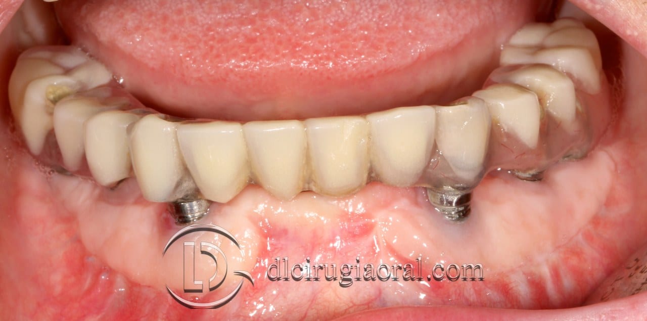 epithelial free graft