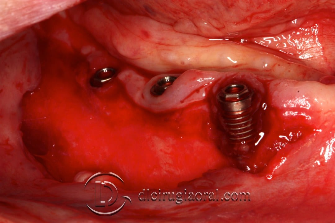 epithelial free graft