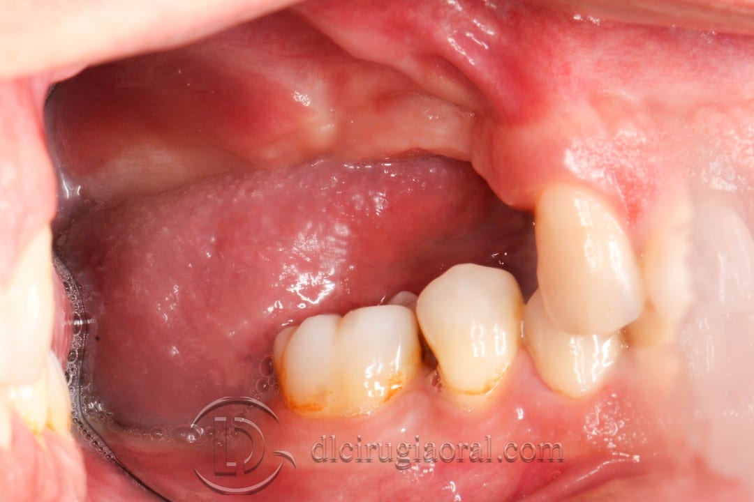 post-extraction implant connective tissue graft