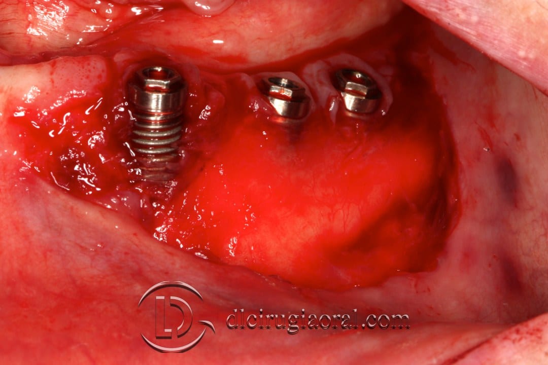 epithelial free graft