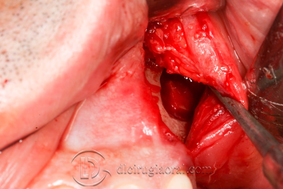 post-extraction implant connective tissue graft