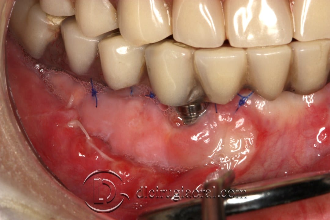 epithelial free graft
