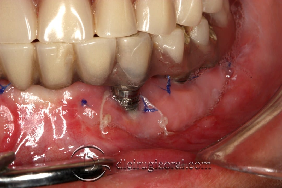 epithelial free graft