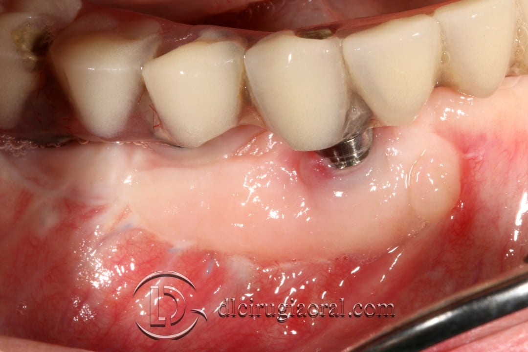 epithelial free graft