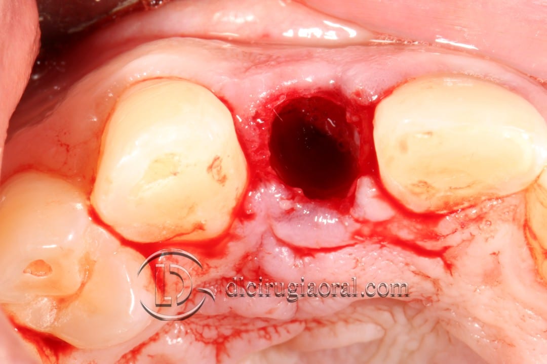 post-extraction implant connective tissue graft