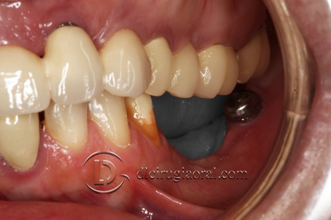 Gaining Height in Posterior Mandible: 3D Bone Reconstruction Case
