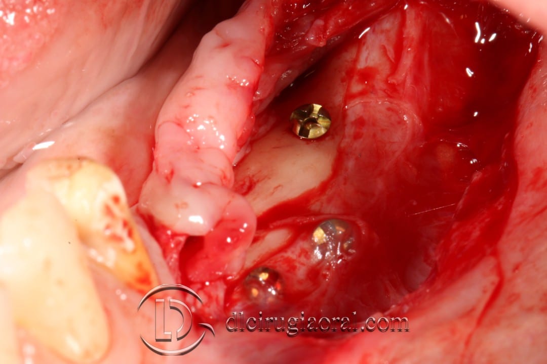 gaining height in posterior mandible