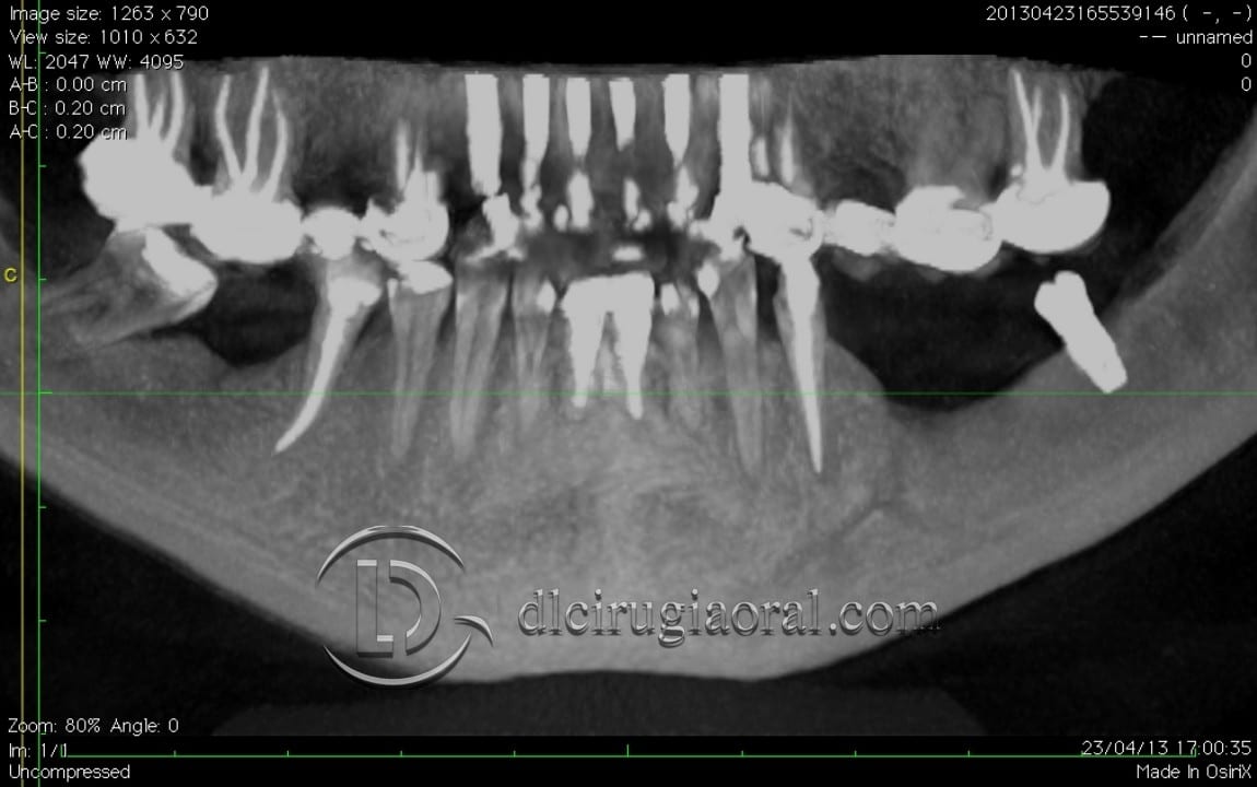 gaining height in posterior mandible