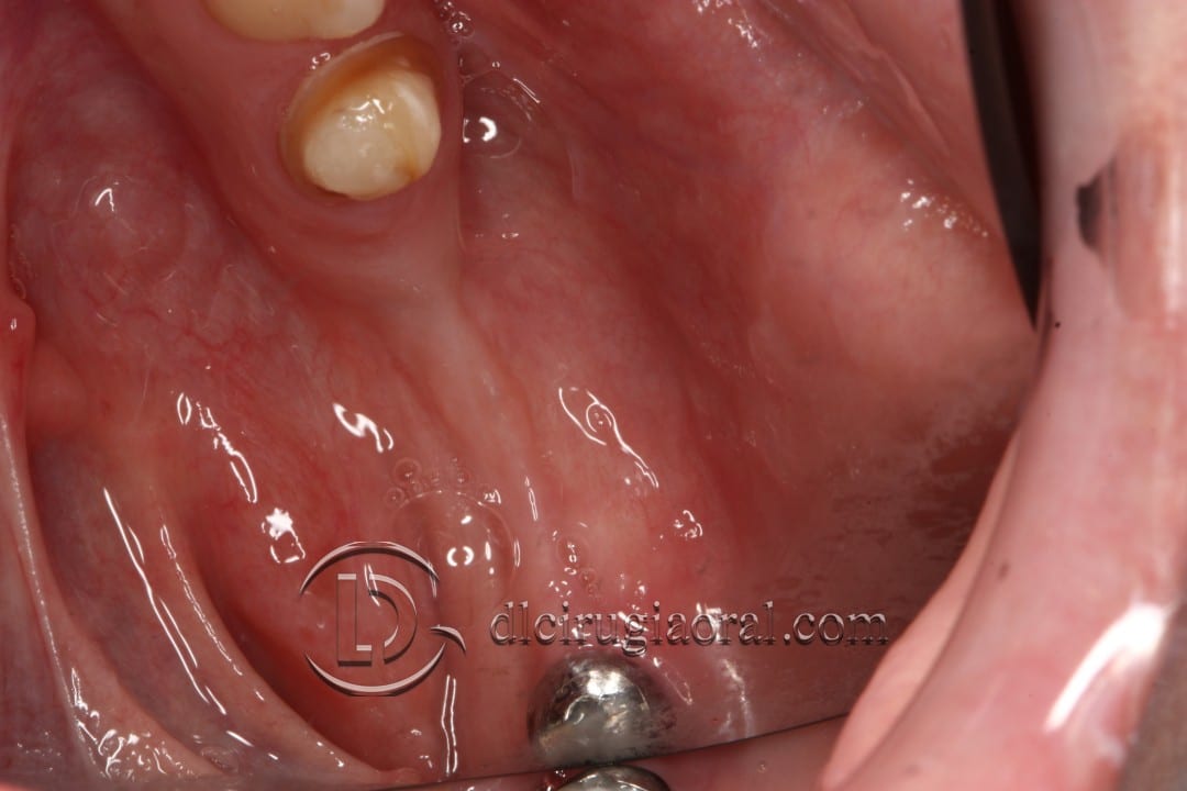 gaining height in posterior mandible