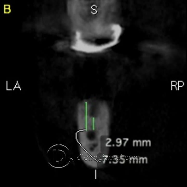 gaining height in posterior mandible