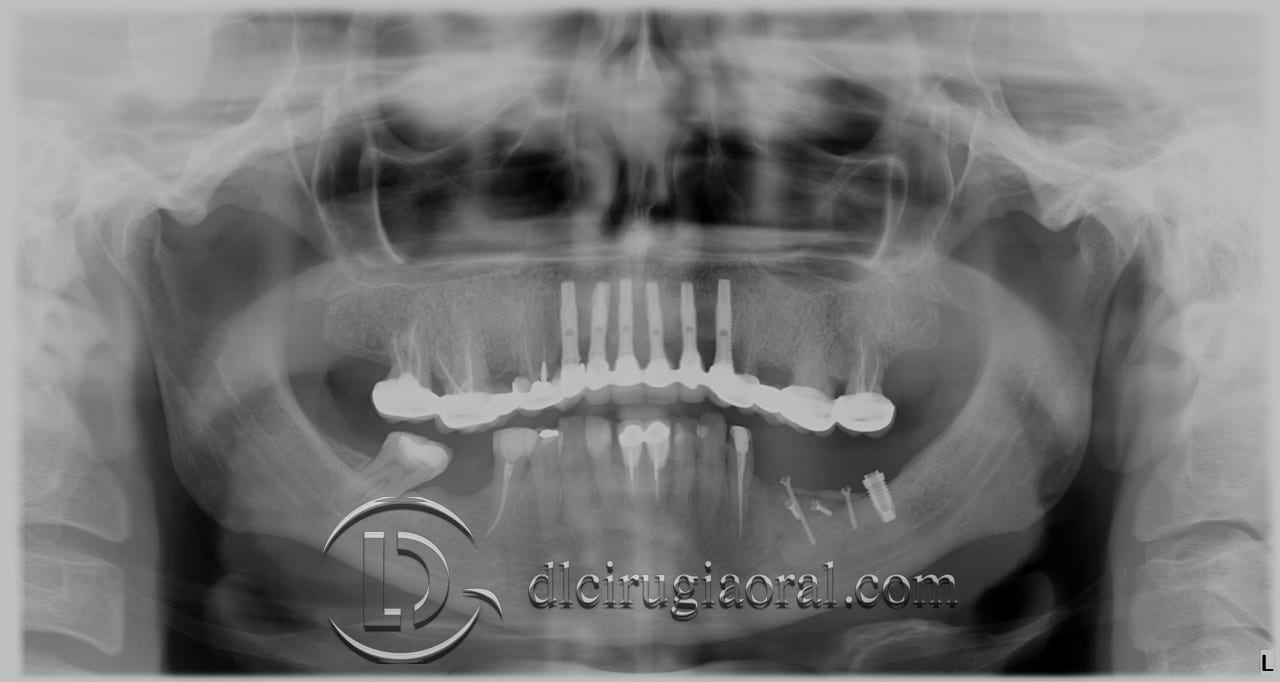 gaining height in posterior mandible