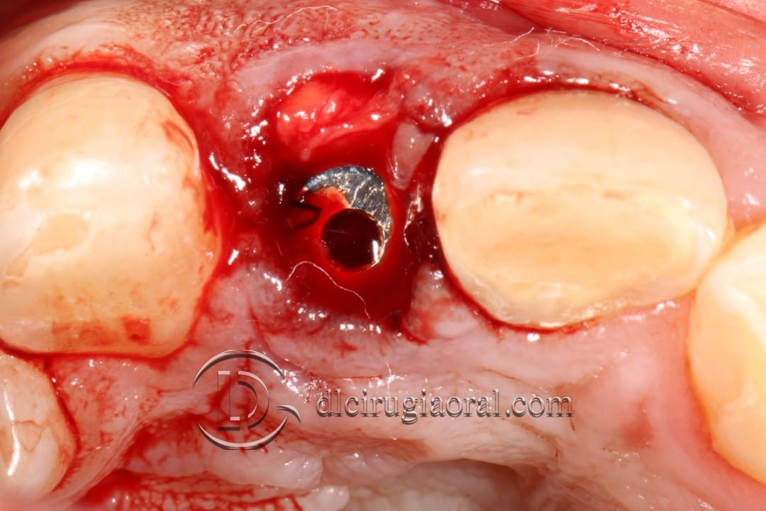 post-extraction implant connective tissue graft