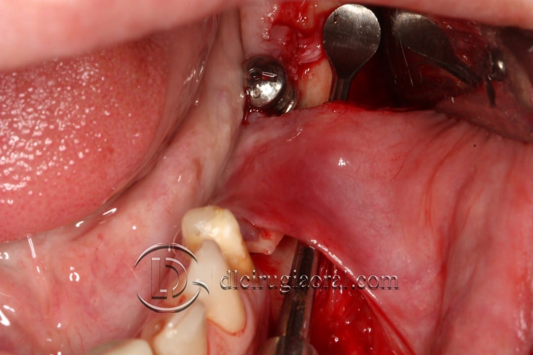 gaining height in posterior mandible