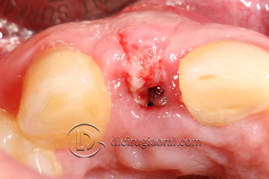 post-extraction implant connective tissue graft