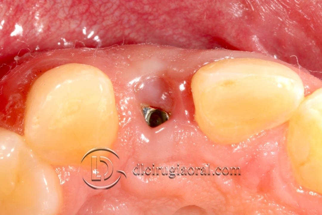 Post-Extraction Implant Connective Tissue Graft: Follow-Up