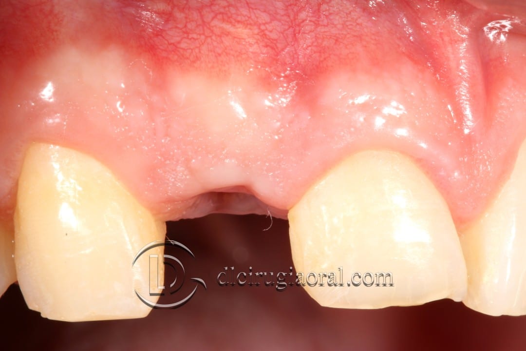 post-extraction implant connective tissue graft