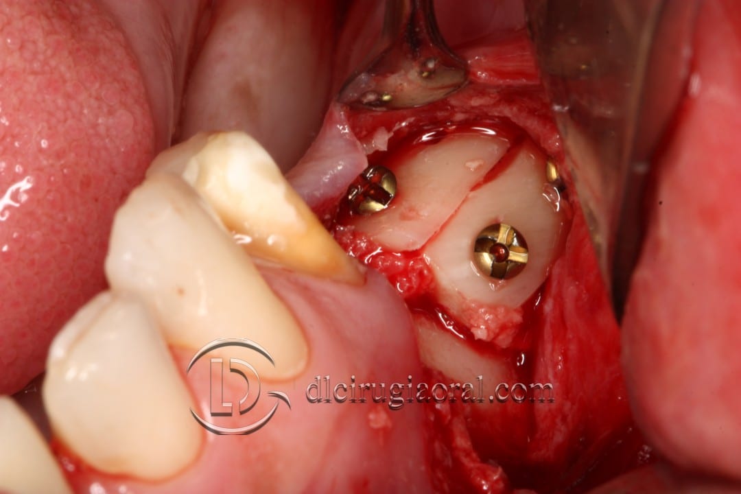 gaining height in posterior mandible
