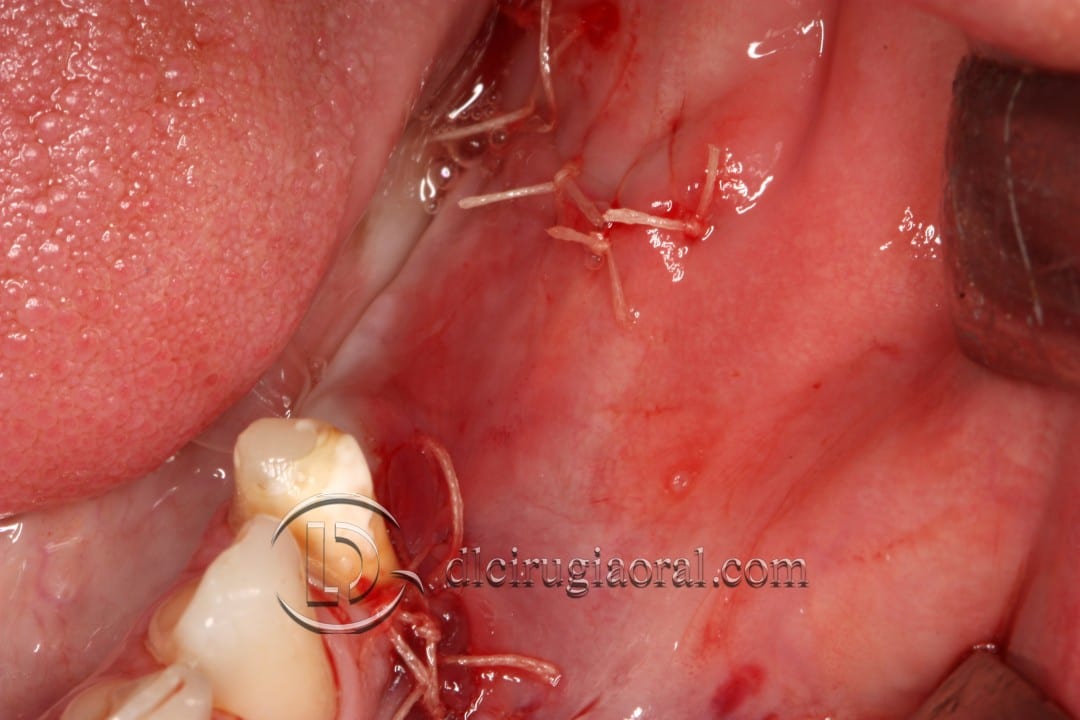 gaining height in posterior mandible