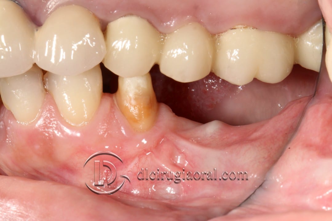 gaining height in posterior mandible