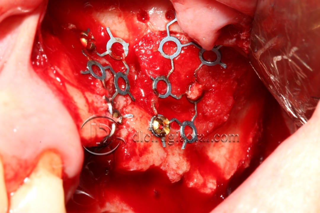 regeneration and sinus lift surgery