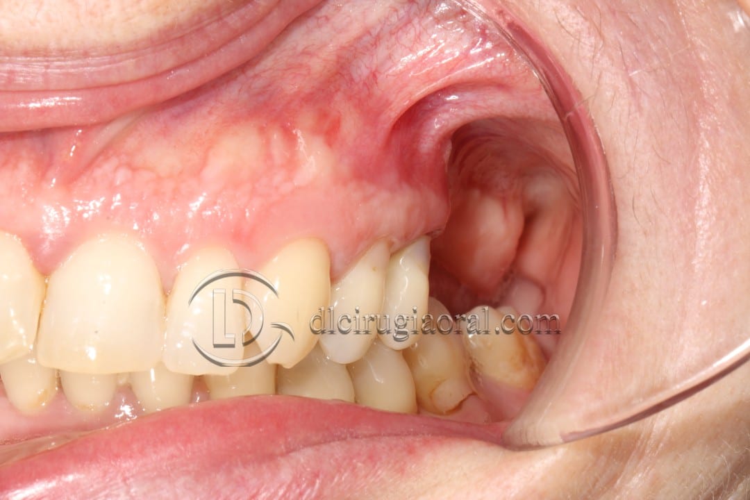 Schneiderian membrane perforation