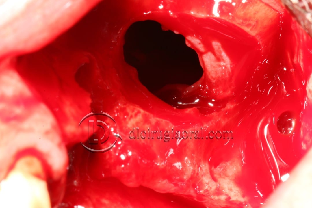 Schneiderian Membrane Perforation During Sinus Lift Surgery