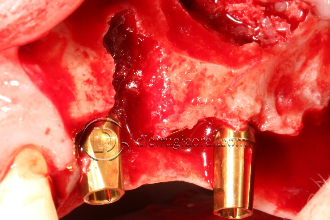 regeneration and sinus lift surgery