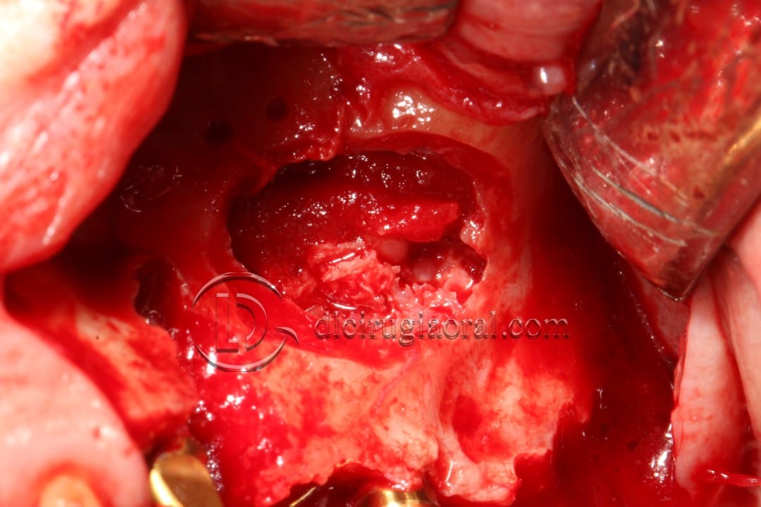 Schneiderian membrane perforation