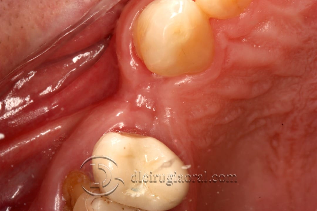 horizontal defect in upper molar
