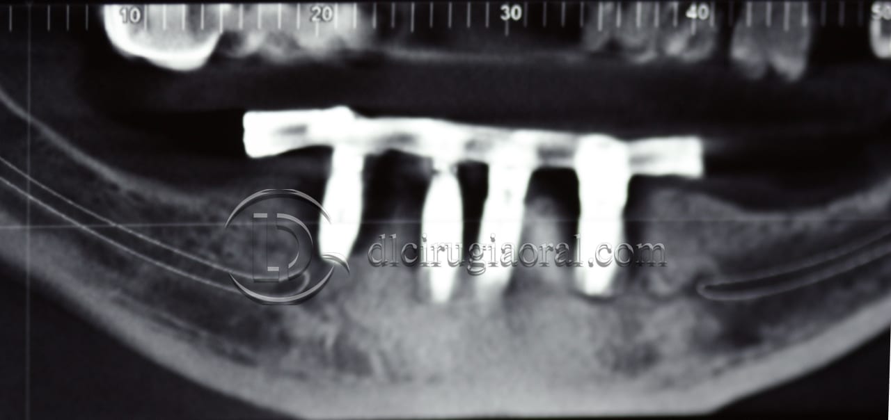 lower overdenture explantation and implantation