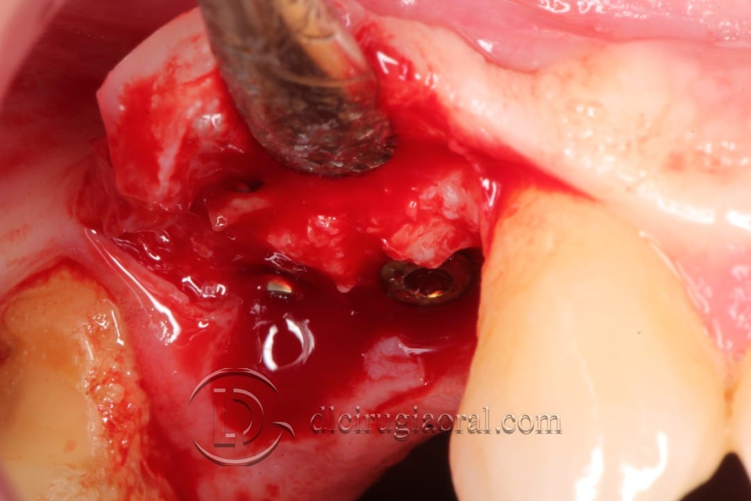 horizontal defect in upper molar