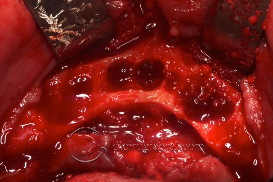 lower overdenture explantation and implantation