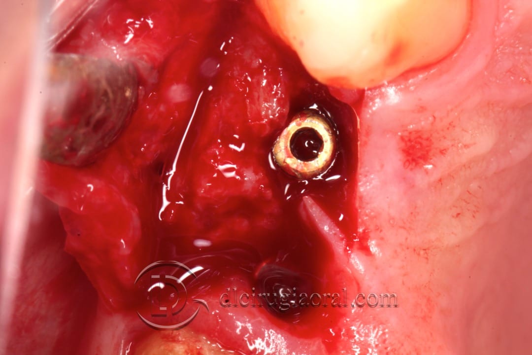 horizontal defect in upper molar