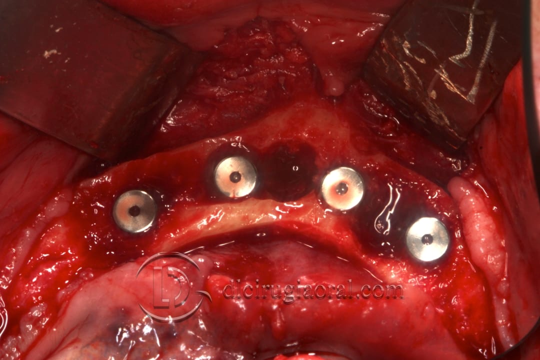 lower overdenture explantation and implantation