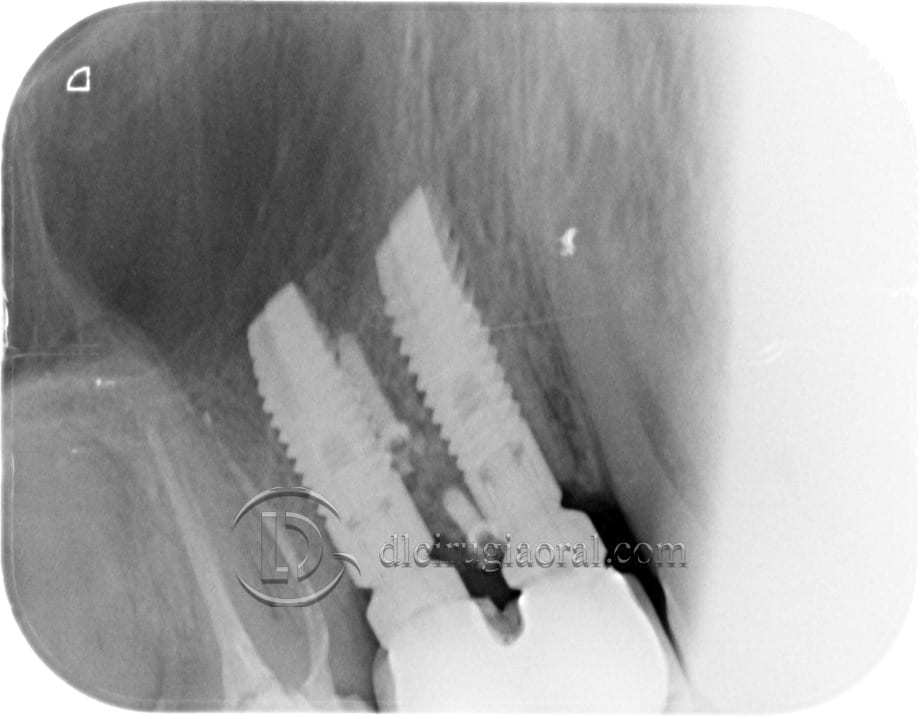 horizontal defect in upper molar