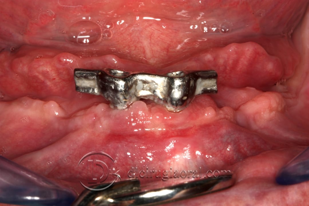 lower overdenture explantation and implantation