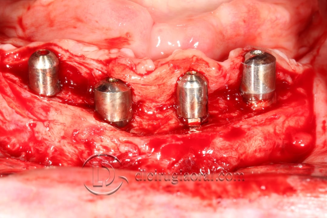 lower overdenture explantation and implantation