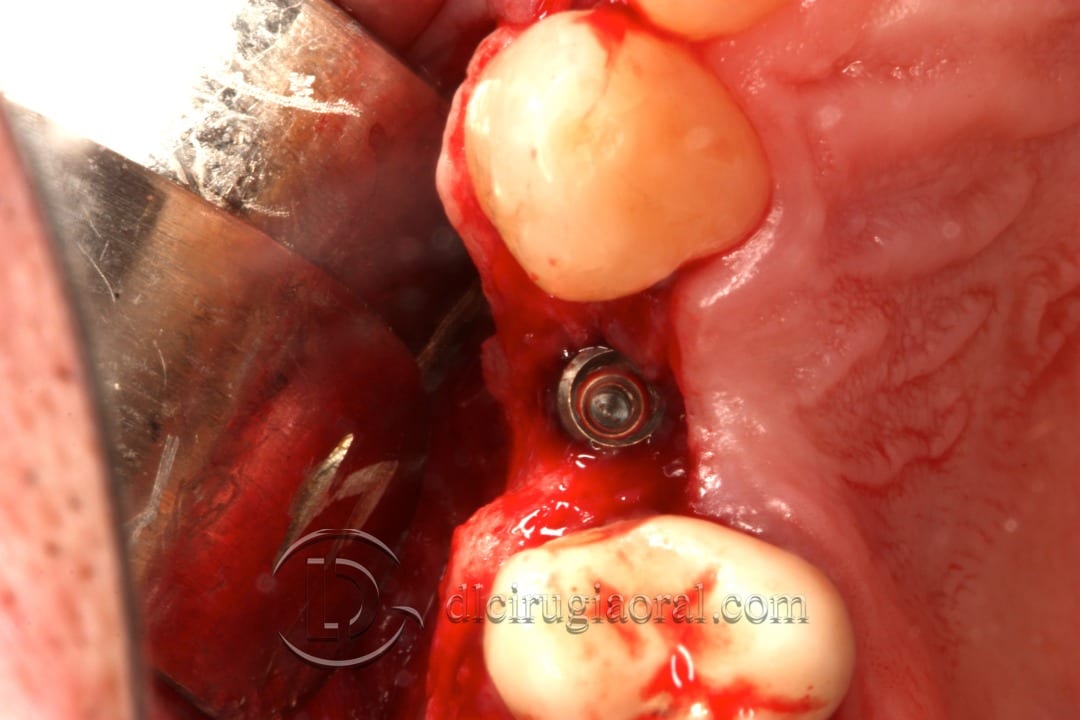 horizontal defect in upper molar