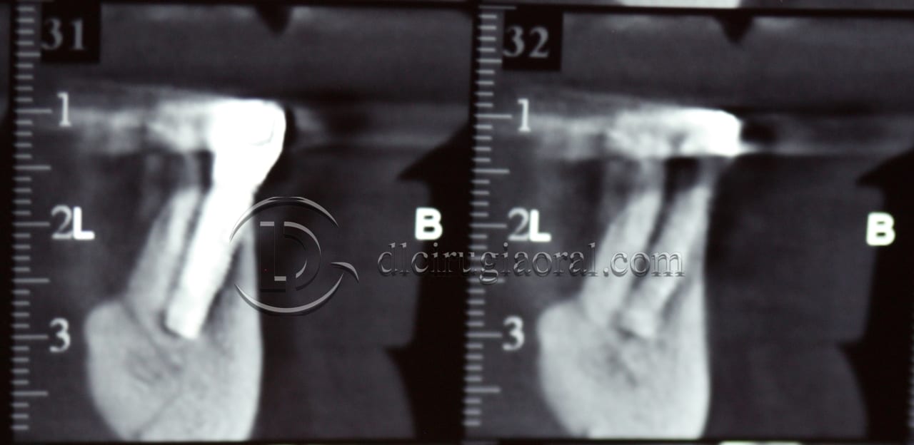 lower overdenture explantation and implantation