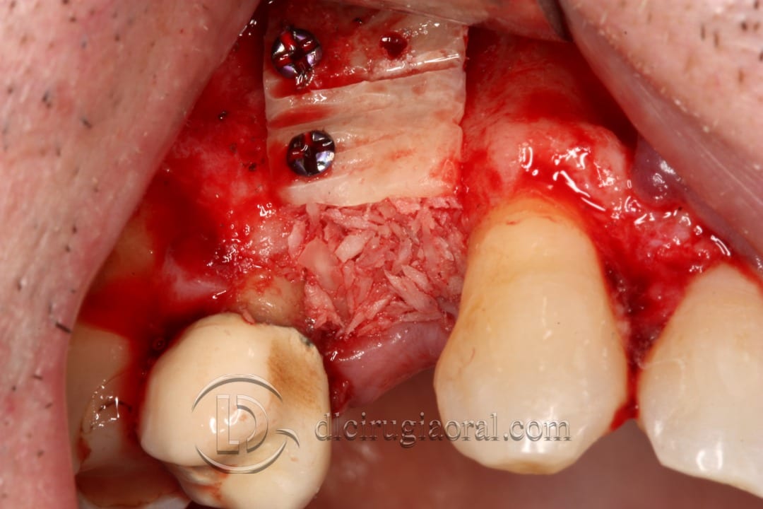 horizontal defect in upper molar