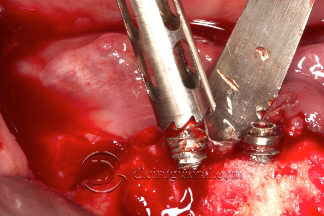 lower overdenture explantation and implantation