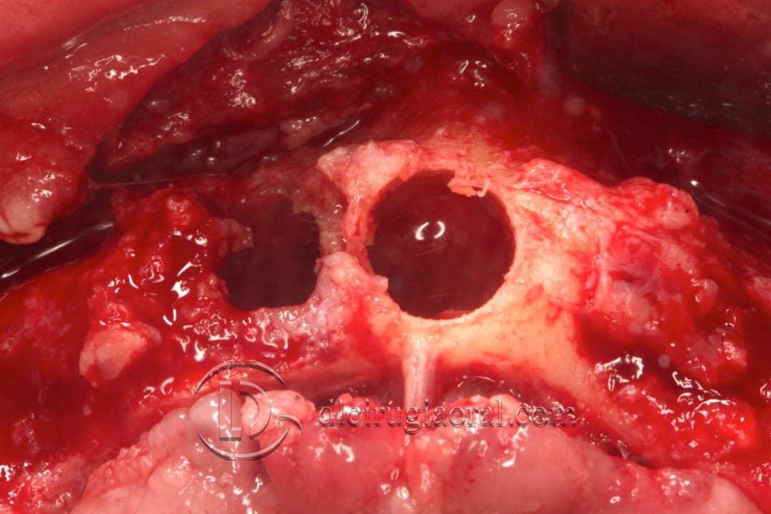 lower overdenture explantation and implantation