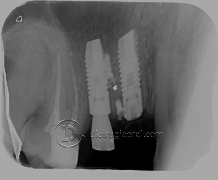 horizontal defect in upper molar