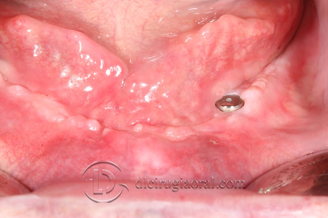 lower overdenture soft tissue improvement