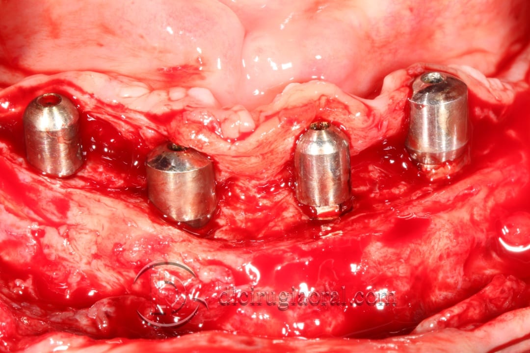 lower overdenture soft tissue improvement
